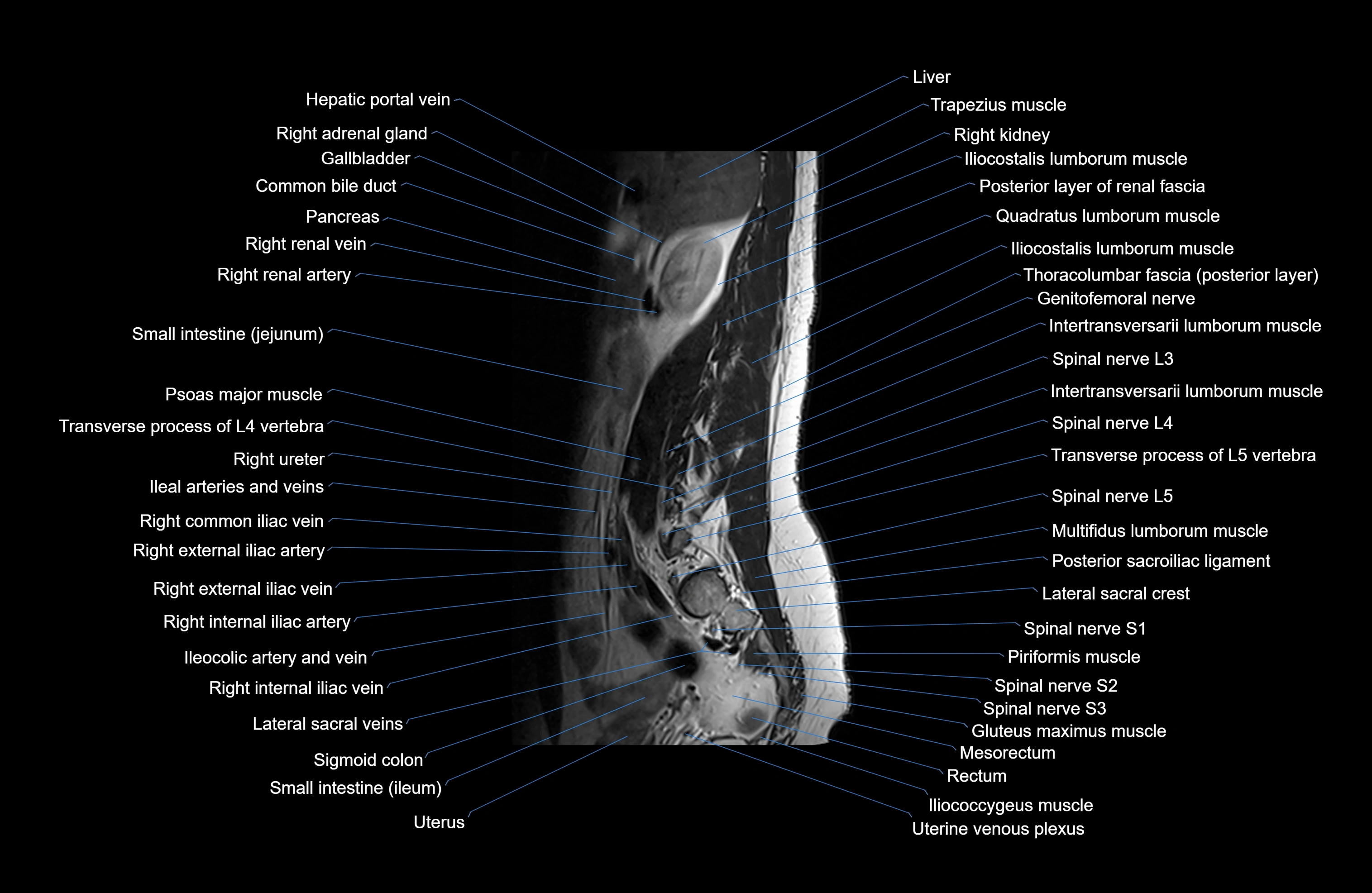 MRI lumbar spine sagittal cross sectional anatomy 3T radiology  image-img-00001-00002.webp